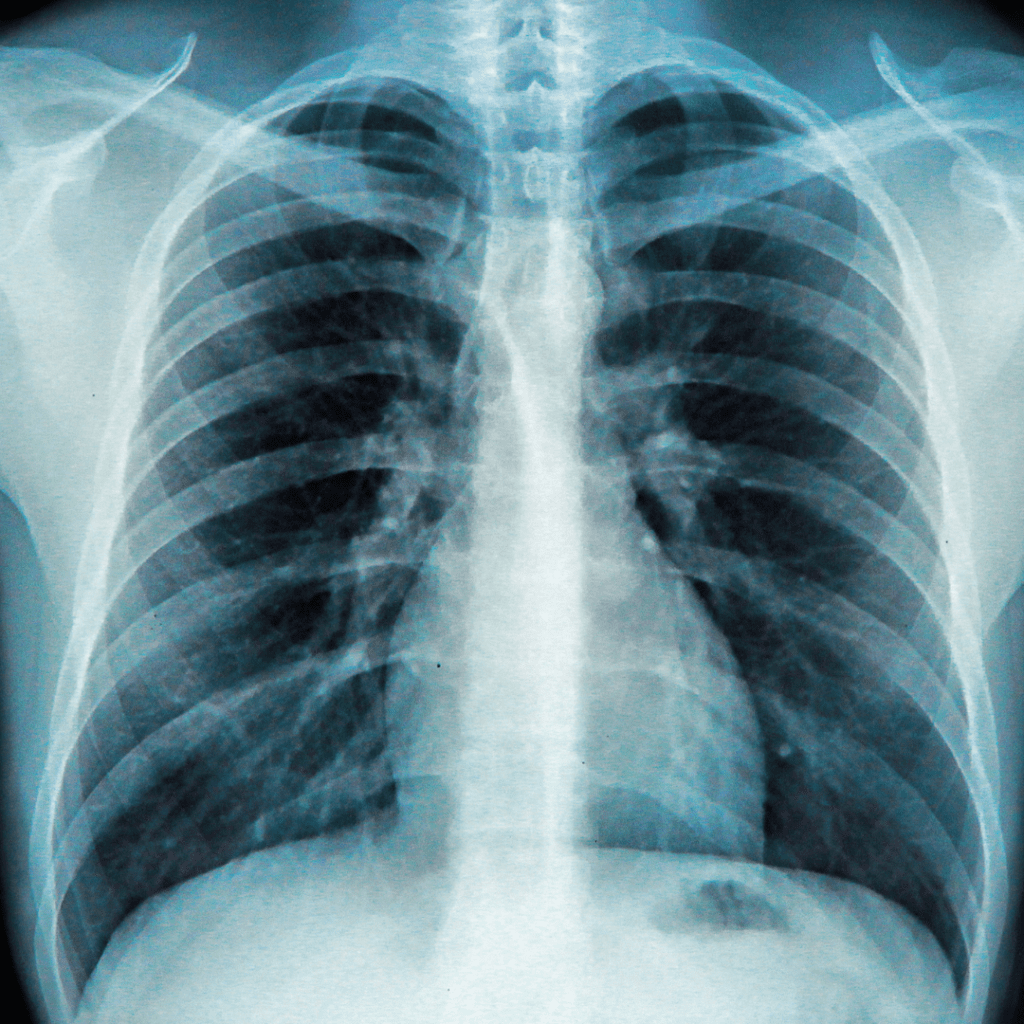 Chest Xrays